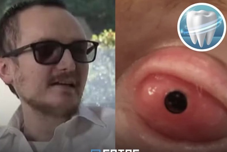 Canadense implanta dente no olho e passa a enxergar novamente após 20 anos.