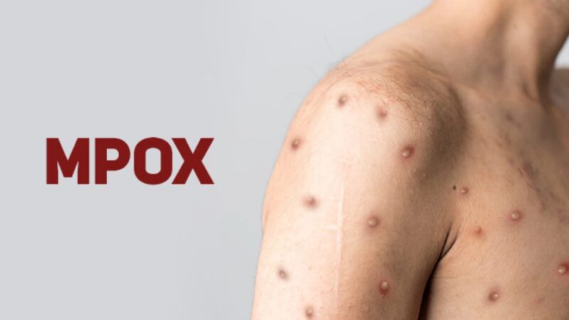 Brasil registra 88 casos de Mpox em 2026; saiba como evitar a doença